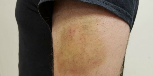 How do I remove a bruise, if after the injury was more than a day