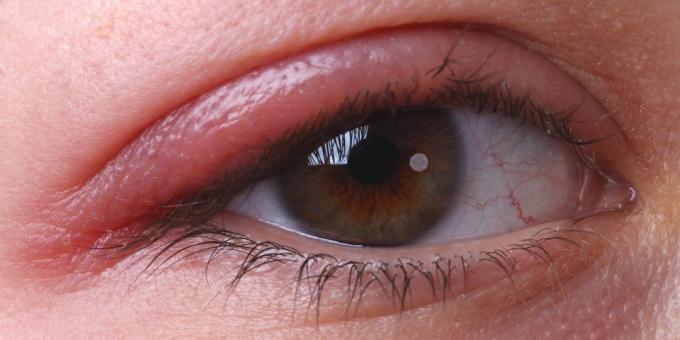 Why itchy eyes: blepharitis