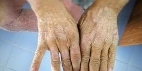 What is scleroderma and how is it treated?
