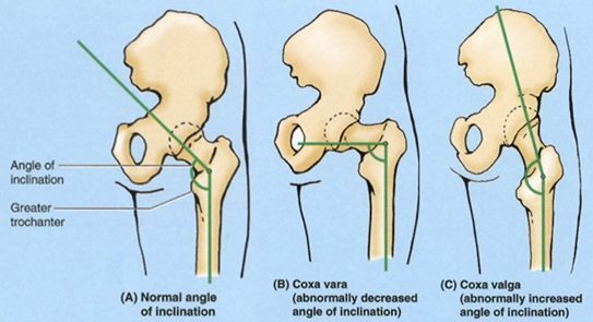Different location of the femoral neck