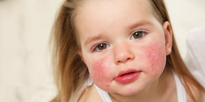 Facial rash: food allergy