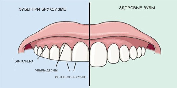 Teeth grinding: Healthy teeth and teeth during bruxism