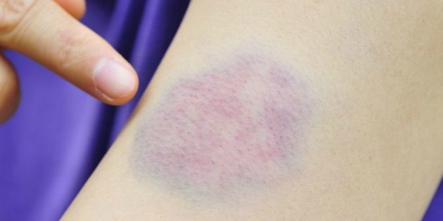 How do I remove a bruise, if after the injury was more than a day