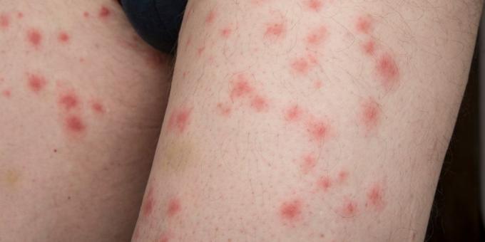 Body rash: insect bites