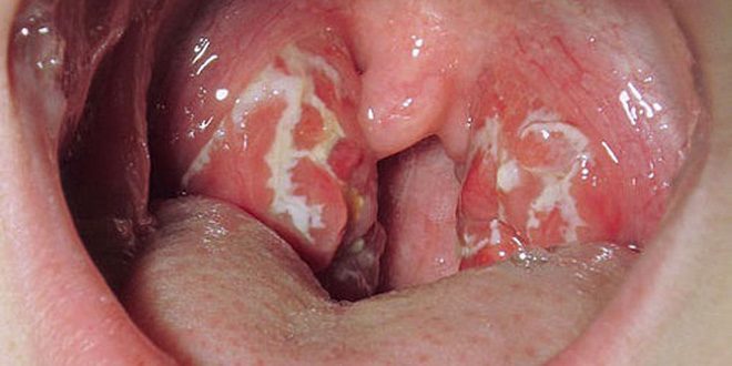 symptoms of tonsillitis