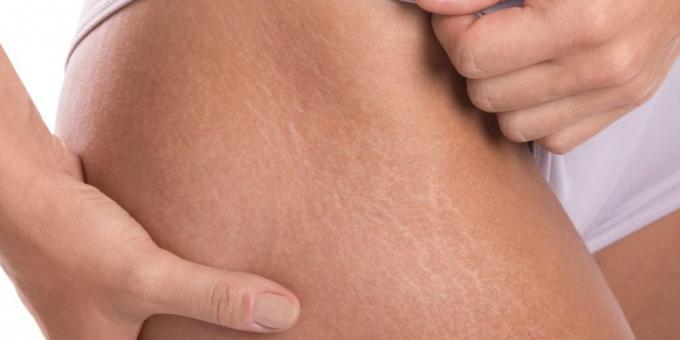 How to get rid of stretch marks: Stretch marks