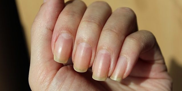 Yellow nails due to red or orange nail polish