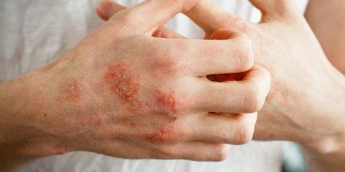 Eczema