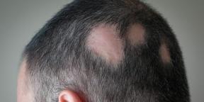 Alopecia: why you are losing hair and how to treat it