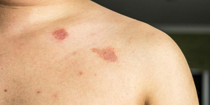 Body rash: ringworm