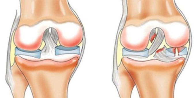 Why hurt your knees: anterior cruciate ligament rupture