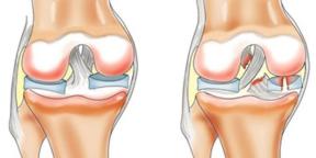 Why knees hurt and what to do