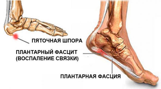 plantar fasciitis