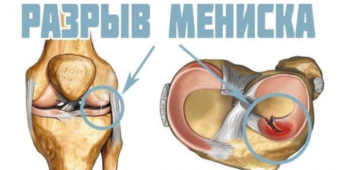 Why hurt your knees: Meniscus injury