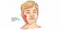 Where does mumps come from, what are its symptoms and how to treat it