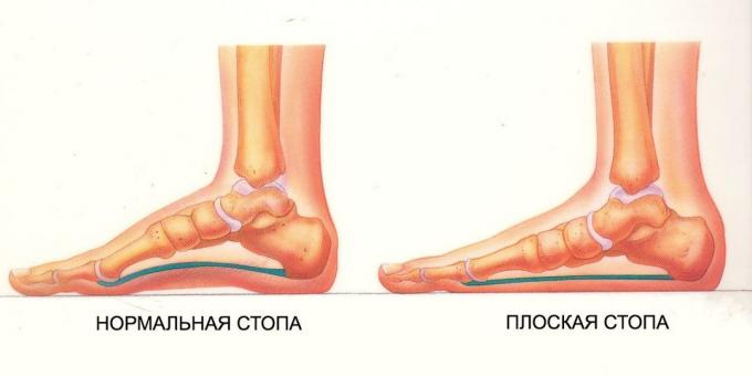 exercises for flat feet: normal and flat foot