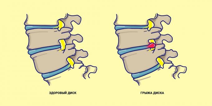 Hernia spine compared with a healthy back