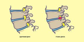 What is sciatica and how to treat it