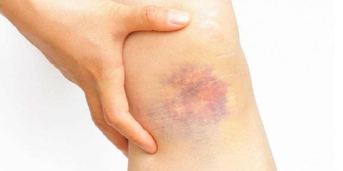 How do I remove a bruise, if after the injury took place less than a day
