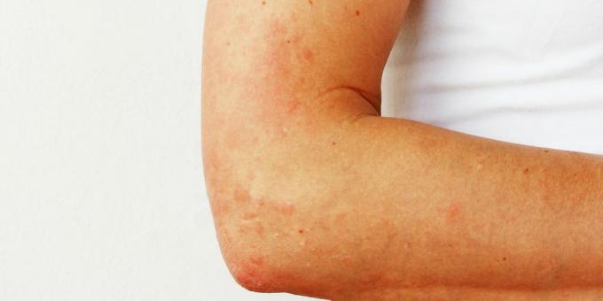 Rash on the hands: photoallergy