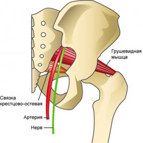 What is piriformis syndrome and how to get rid of it