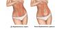 Where does diastasis come from and how to get rid of it