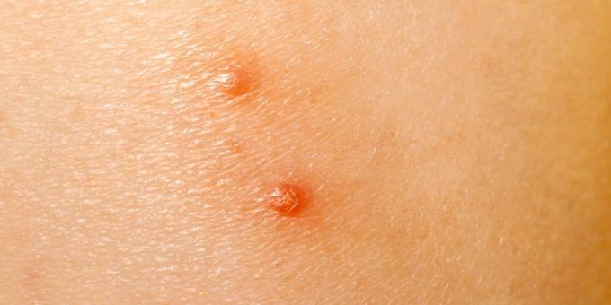 Body rash: molluscum contagiosum