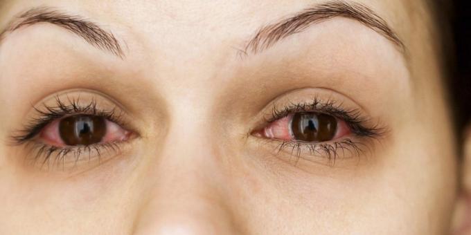 Why itchy eyes, conjunctivitis