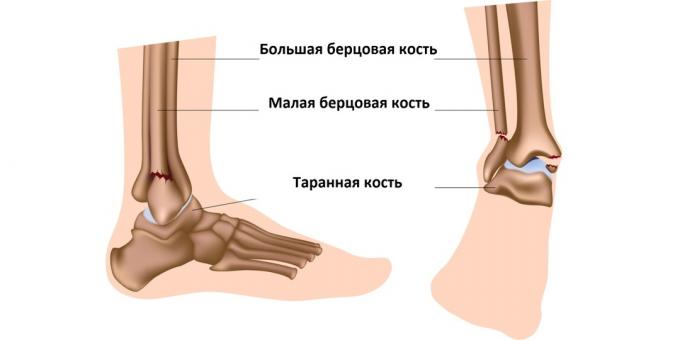 Ankle fracture affects the bones that make up the ankle