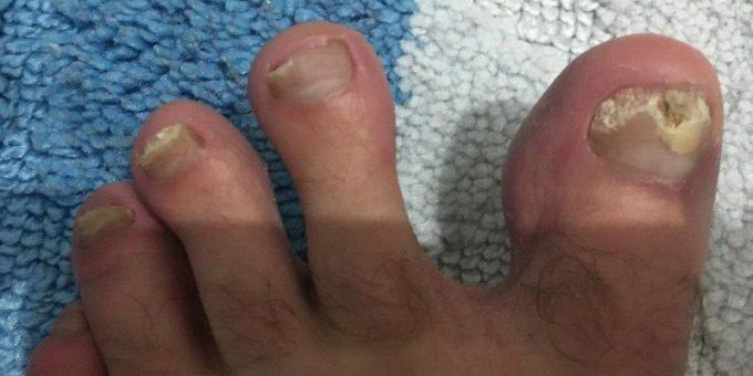 Nail fungus, which is not treated