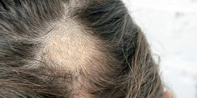 Infectious alopecia