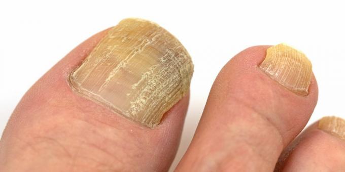 Dermatomycosis: nail fungus