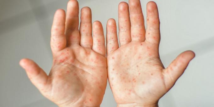 Coxsackie virus symptoms: rash