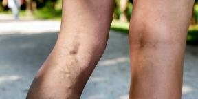 Where does the varicose veins and how to treat it