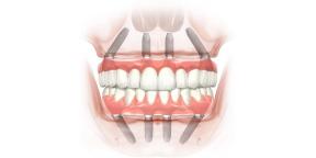 How to restore your teeth and smile back