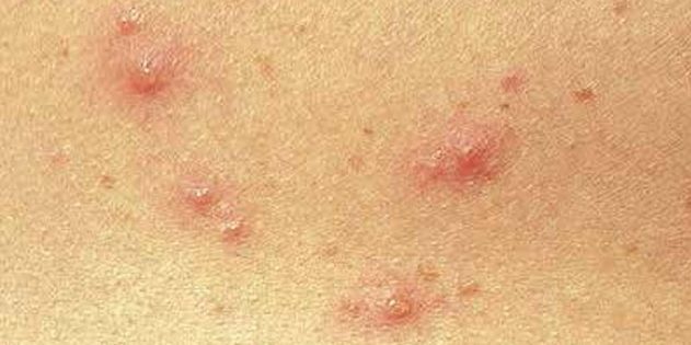 Symptoms of chickenpox in children and adults: Quite often, the skin immediately appear small red dots