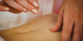 Acupuncture: What is worth knowing about the treatment thin needles