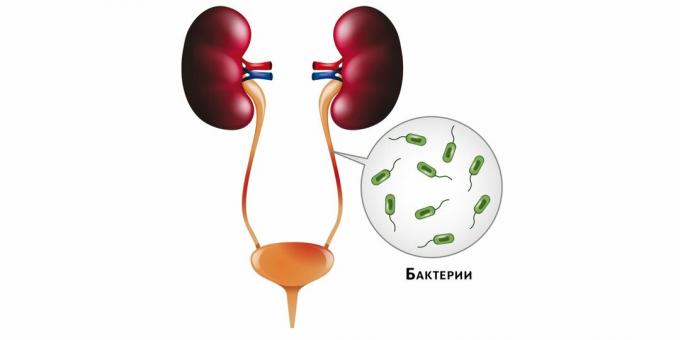 With pyelonephritis, bacteria enter the kidneys