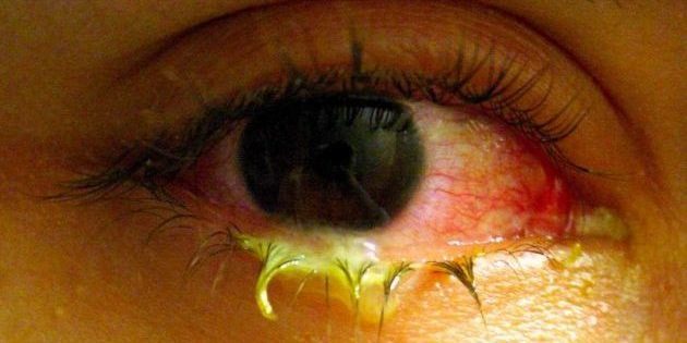 Discharge from the eye with conjunctivitis