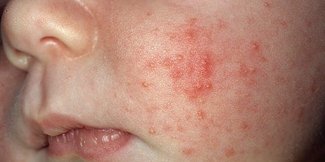 How to Get Rid of Acne: Acne Infant
