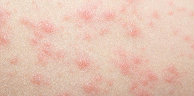 Skin rash with drug allergies